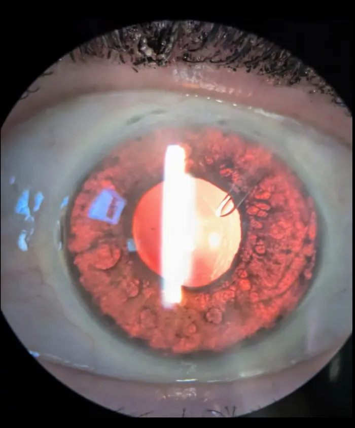 An eye with an Ahmed glaucoma valve tube visible inside the front chamber