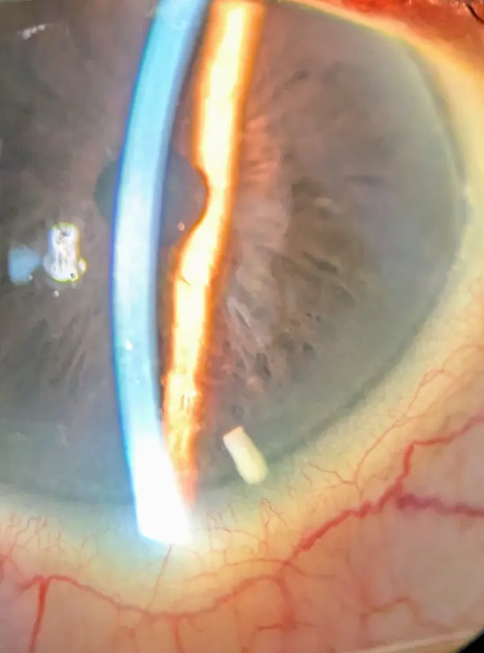 A Durysta implant resting in the drainage angle of the eye